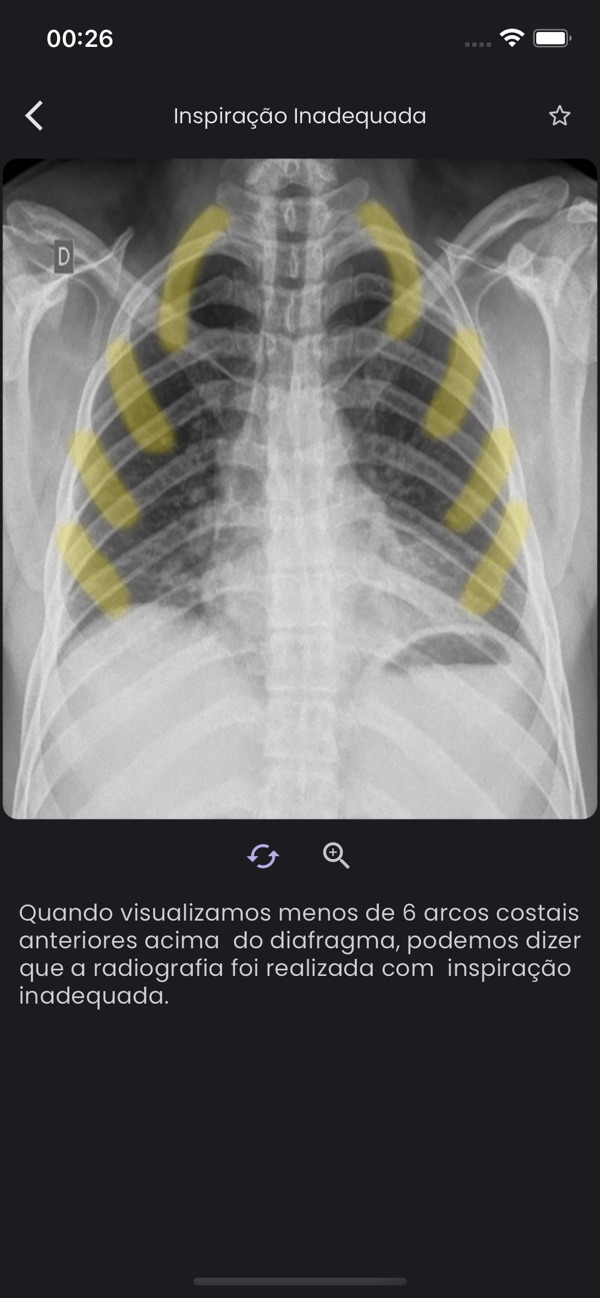 TóraxApp: lição sobre inspiração inadequada com arcos costais destacados