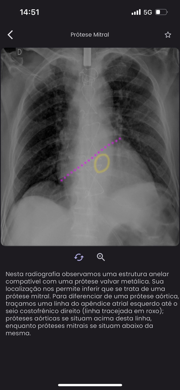 TóraxApp: análise de prótese mitral em radiografia