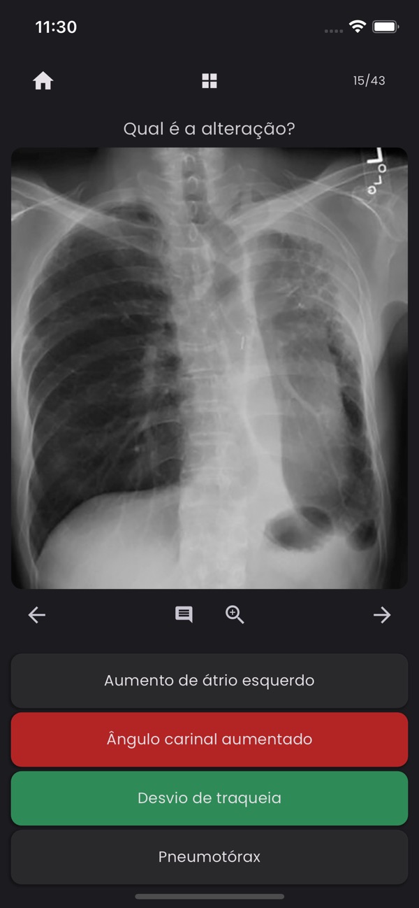 TóraxApp: exercício perguntando a alteração em uma radiografia de tórax